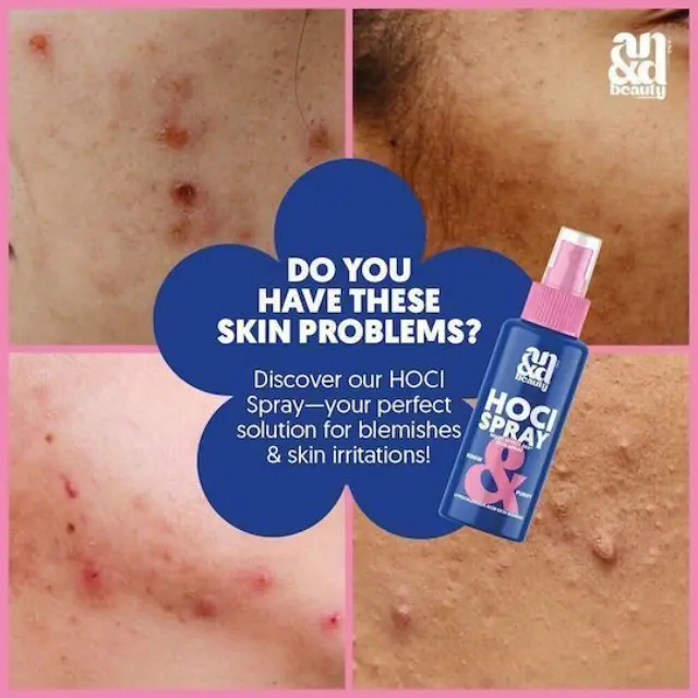 A.N.D. Beauty Hocl Spray Σπρέι υποχλωριώδους οξέος για Επούλωση, Ακμή + Εγκαύματα MINI-TRAVEL SIZE) 30ml 2