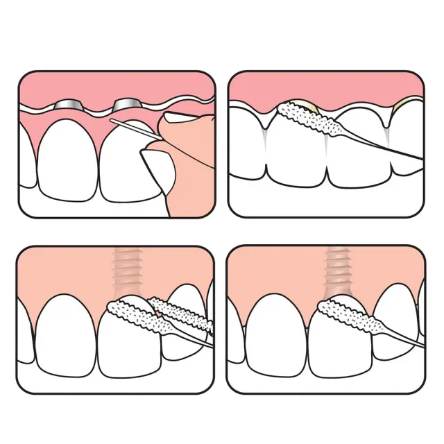 TePe Bridge & Implant Floss Σπογγώδες Νήμα Καθαρισμού Γεφυρών & Εμφυτευμάτων 30τμχ 2