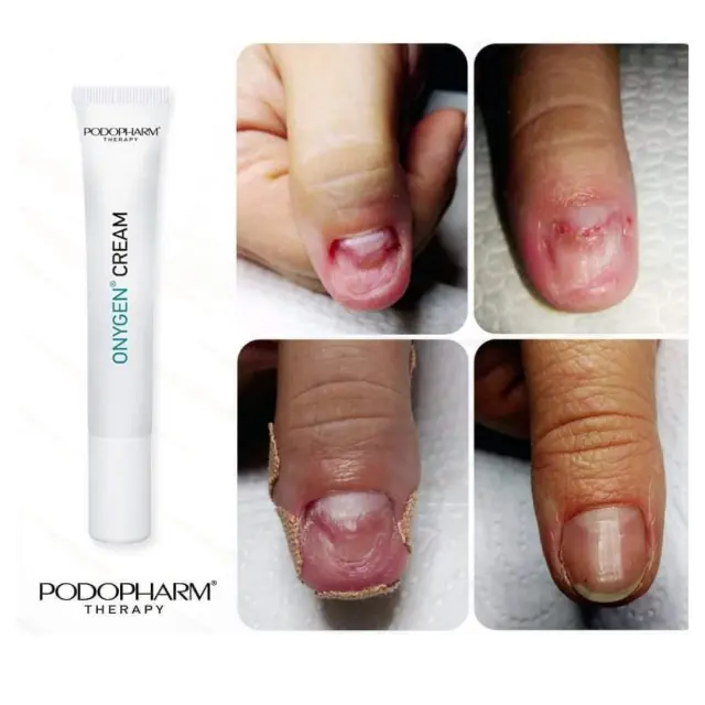 ONYGEN® Cream 3