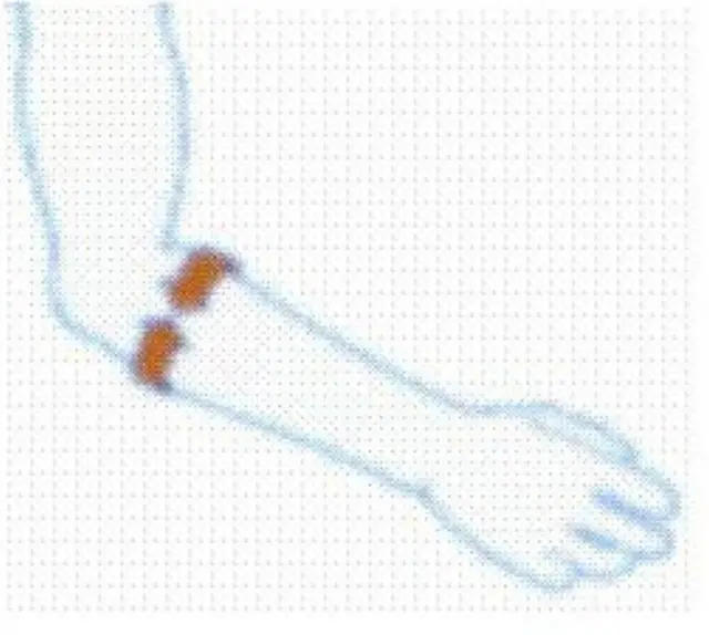 Δέστρα επικονδυλίτιδας (tennis elbow) με σιλικόνη - S 2