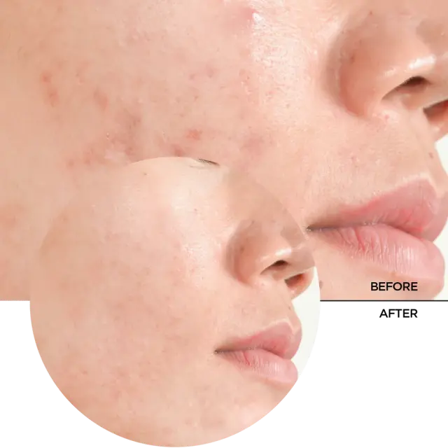 REVOX B77 JUST Salicylic Acid Peeling Solution 2% 30ml 3