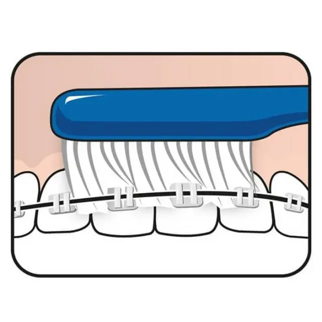 TePe | Implant Orthodontic Oδοντόβουρτσα για Εμφυτεύματα & Ορθοδοντικά Μηχανήματα | 1τεμ 3