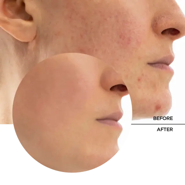 Revox Skintreats Light Gel Προσώπου για Ενυδάτωση, Ανάπλαση & Ρύθμιση Λιπαρότητας με Υαλουρονικό Οξύ & Βιταμίνη C 50ml 3