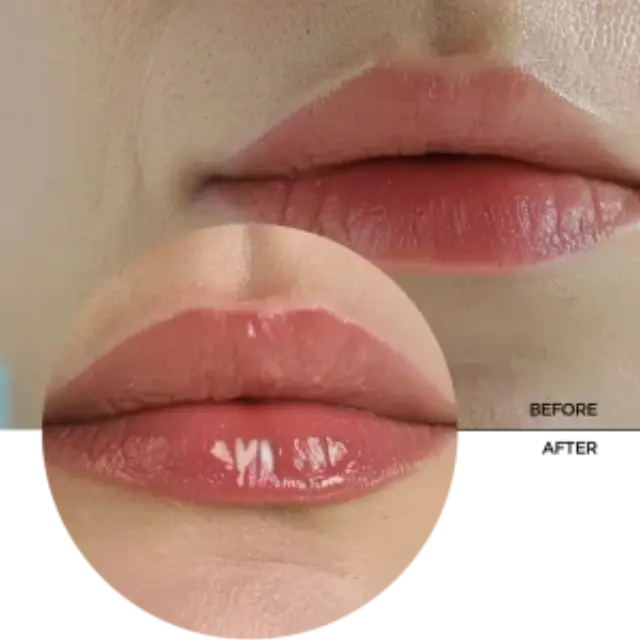 Revox Hyaluronic Acid Lip Filler Κρέμα Χειλιών Hyaluronic Acid 12ml 3