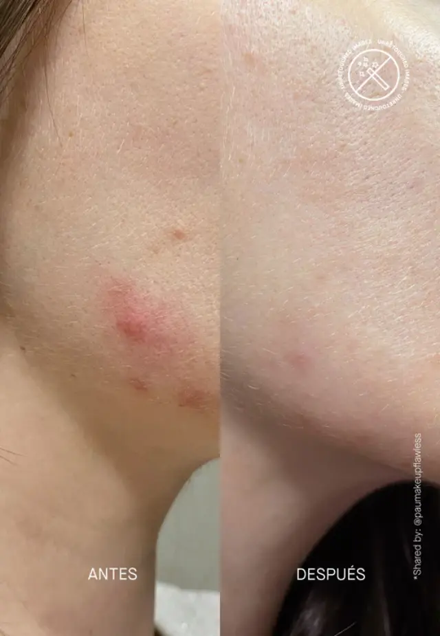 Niche Beauty Lab - Acnemy - Postzit - Θεραπεία μετά την έξαρση 30ml 2