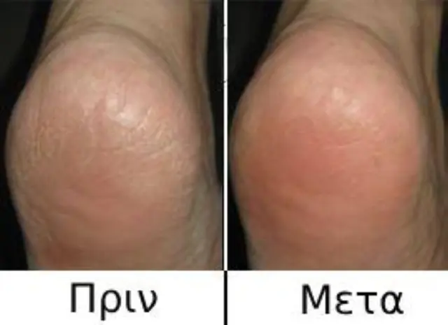 Hansaplast Foot Expert Ενυδατική Κρέμα Ανάπλασης για Σκασμένες Φτέρνες με Ουρία 100ml 2