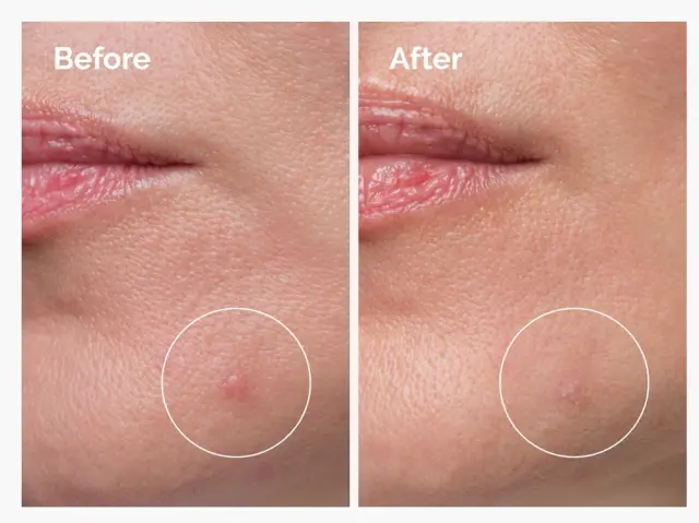 The Ordinary Sulfur 10% Powder to Cream Concentrate Συμπυκνωμένη Φόρμουλα κατά των Ατελειών & της Ακμής, 5g 3