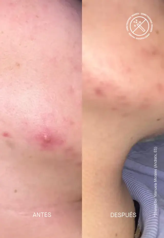 Niche Beauty Lab Acnemy Zitcontrol Κρέμα Προσώπου για Λιπαρές Επιδερμίδες κατά των Ατελειών & της Ακμής με Νιασιναμίδη & Ceramides 40ml 2